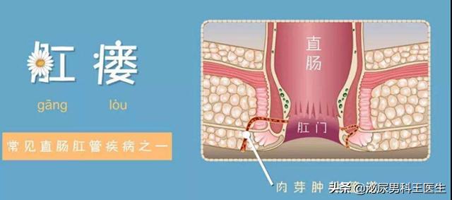 肛瘘不治是不是头疼,为什么肛瘘手术后才是痛苦的开始