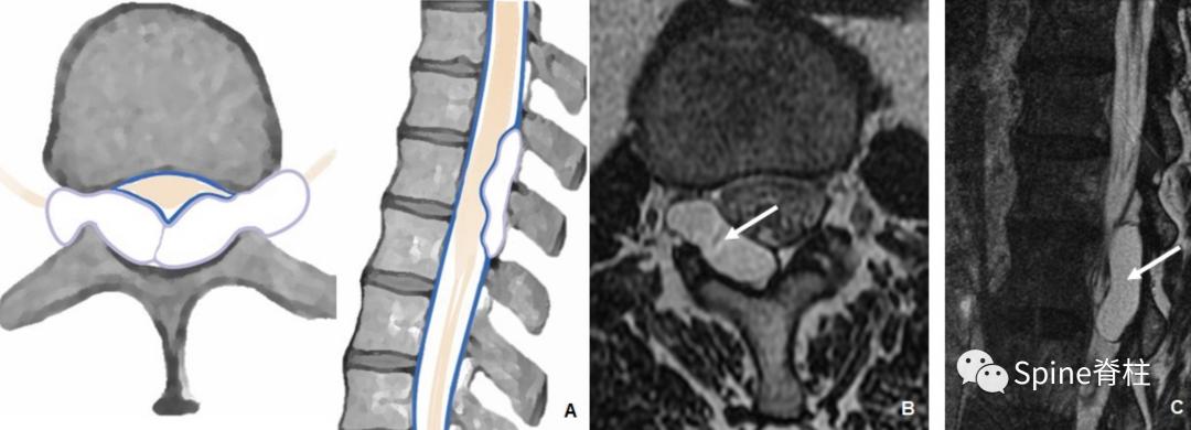 腰椎椎管有囊性结构,水平椎管内囊性占位