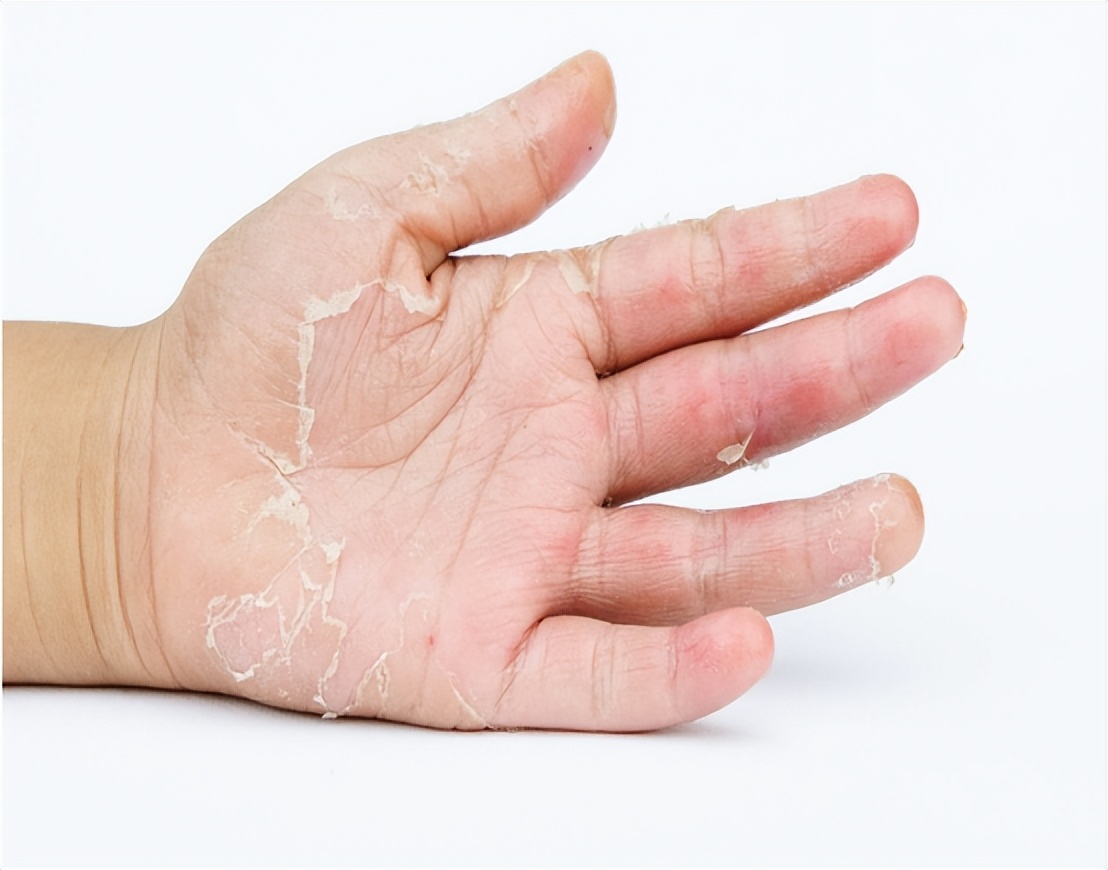 手脱皮开裂痒长癣专用乳膏,手脱皮手癣怎么回事