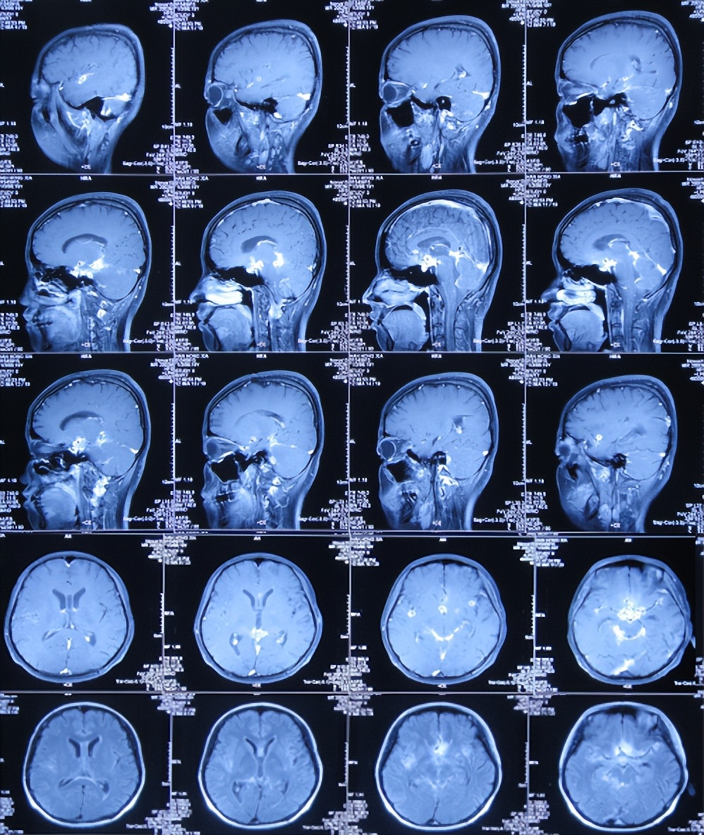 结核性脑积水能治愈吗,儿童结核脑膜炎脑积水