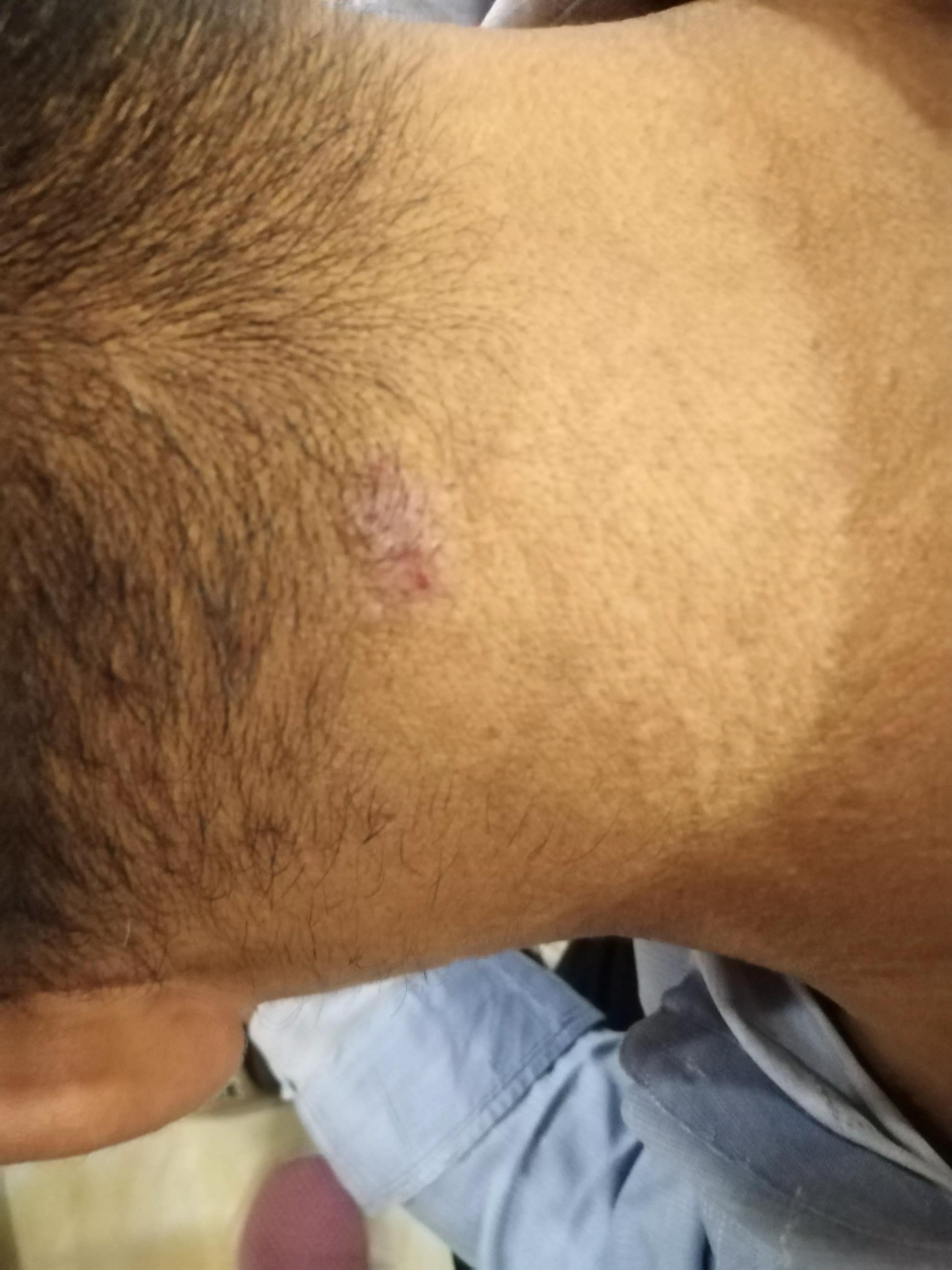 牛皮癣伴随一生是怎么样的体验,对抗牛皮癣一直在坚持