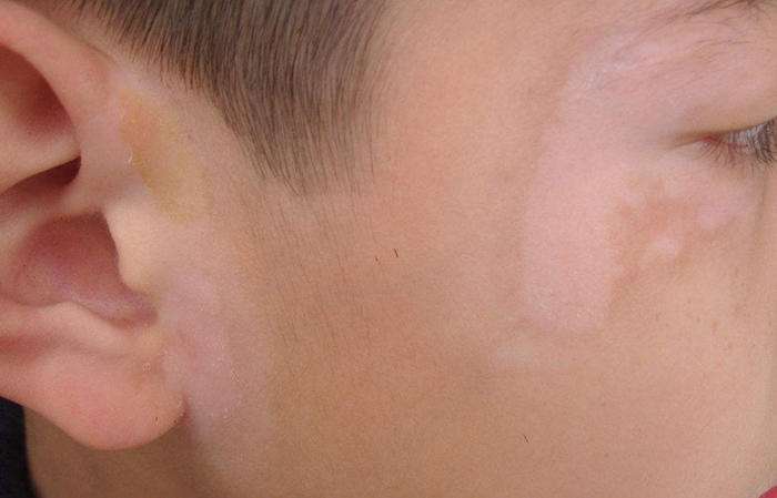 儿童白癜风有治愈的案例吗,儿童白癜风治疗要注意什么