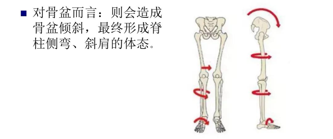 扁平足发病机制,扁平足诊断标准示意图