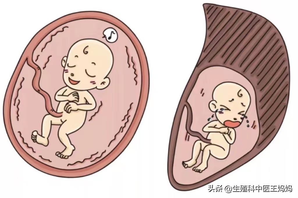 胚胎有停育迹象怎么补救,胚胎停育最明显的4个征兆