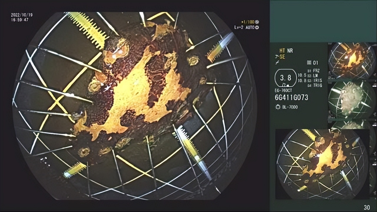 西安市红会医院：七旬老人患食管癌消化内科内镜黏膜下剥离术除烦恼