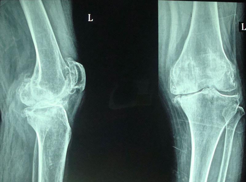 上下楼梯时膝关节痛的原因及康复方法