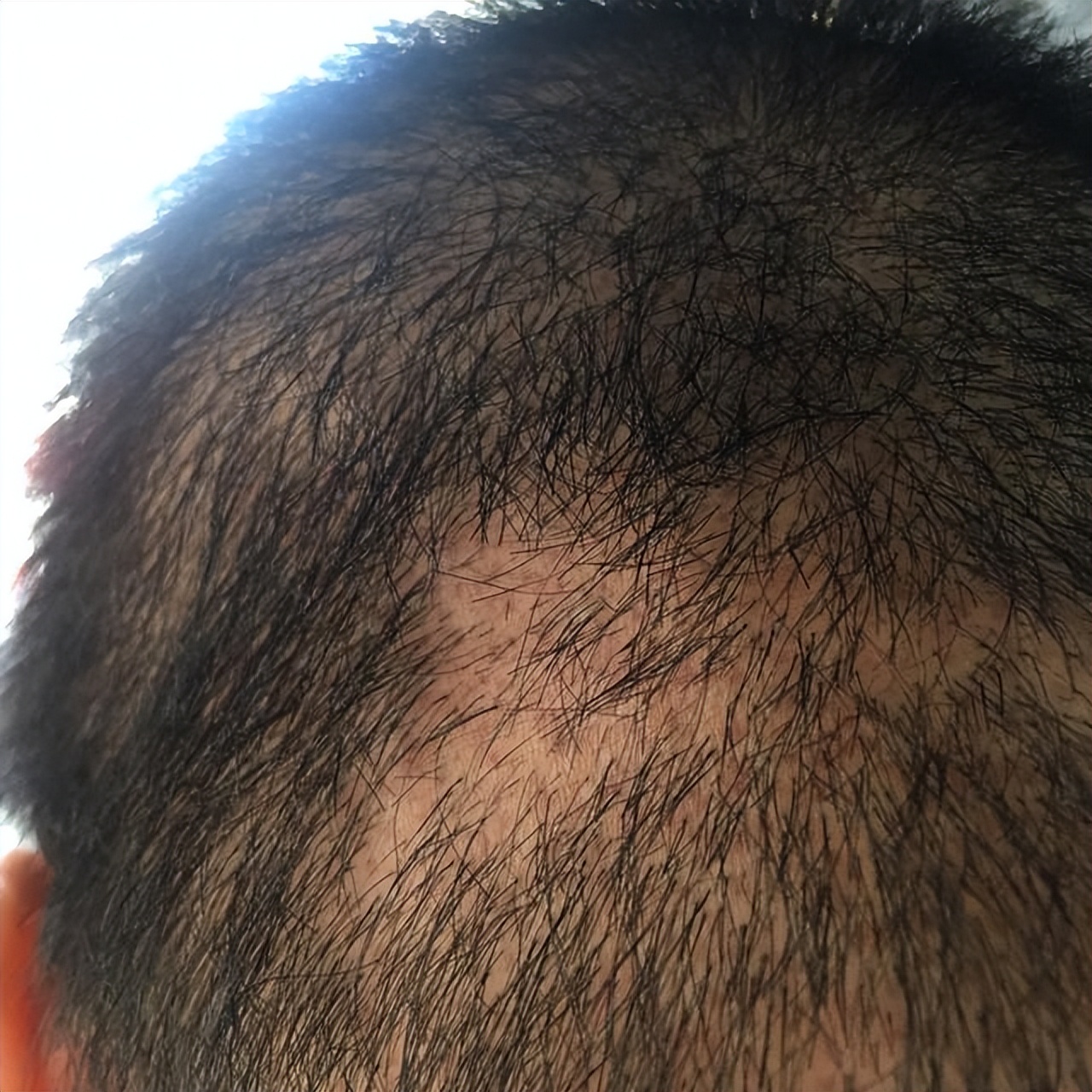 头皮后脑勺长红疙瘩有脓包,为什么头皮上总是长脓包和痘痘