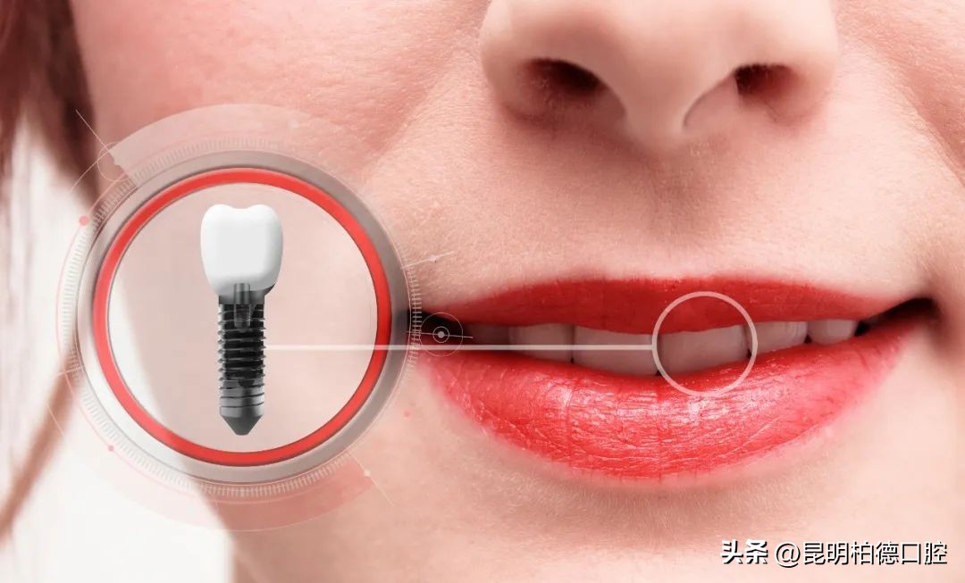 拔牙后能不能马上种假牙,牙医拔牙后镶牙还是种牙