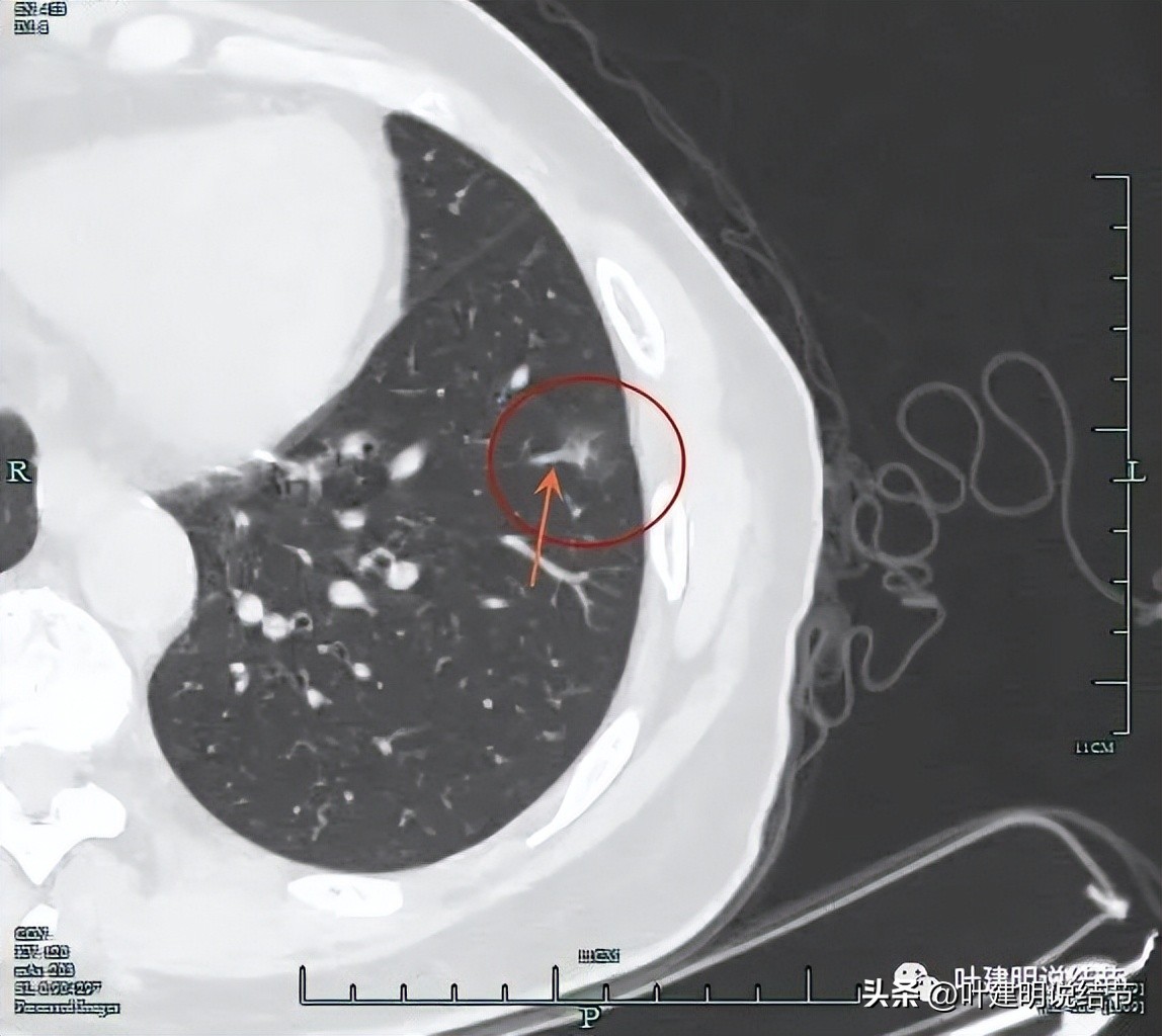 辽宁省肺结节手术哪家医院好,辽宁肺结节手术医院