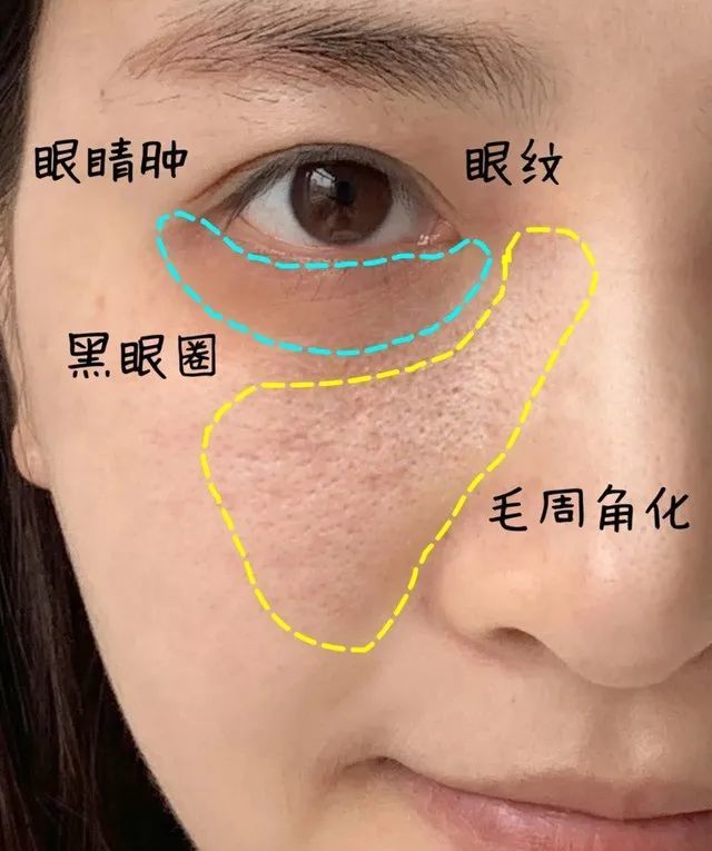 脂肪粒和闭口长什么样,脂肪粒闭口长啥样的