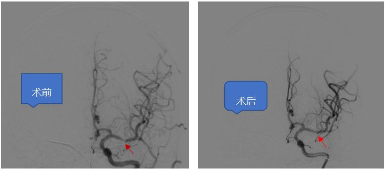 左侧大脑中动脉重度狭窄手术过程,颅内动脉重度狭窄能做手术吗