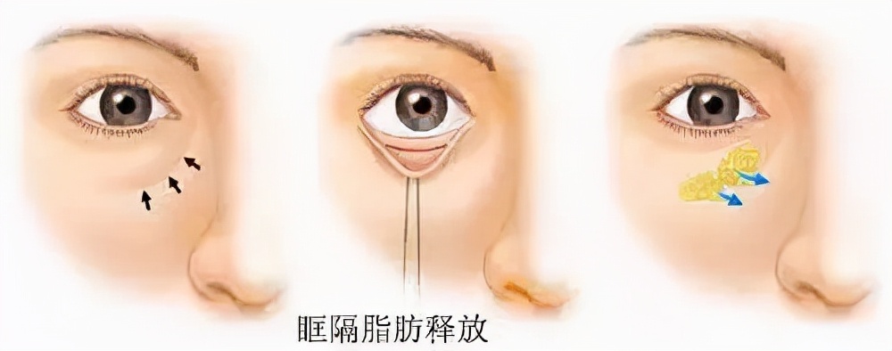 最快的方法帮你淡化泪沟,只需知道一招轻松消除显老泪沟