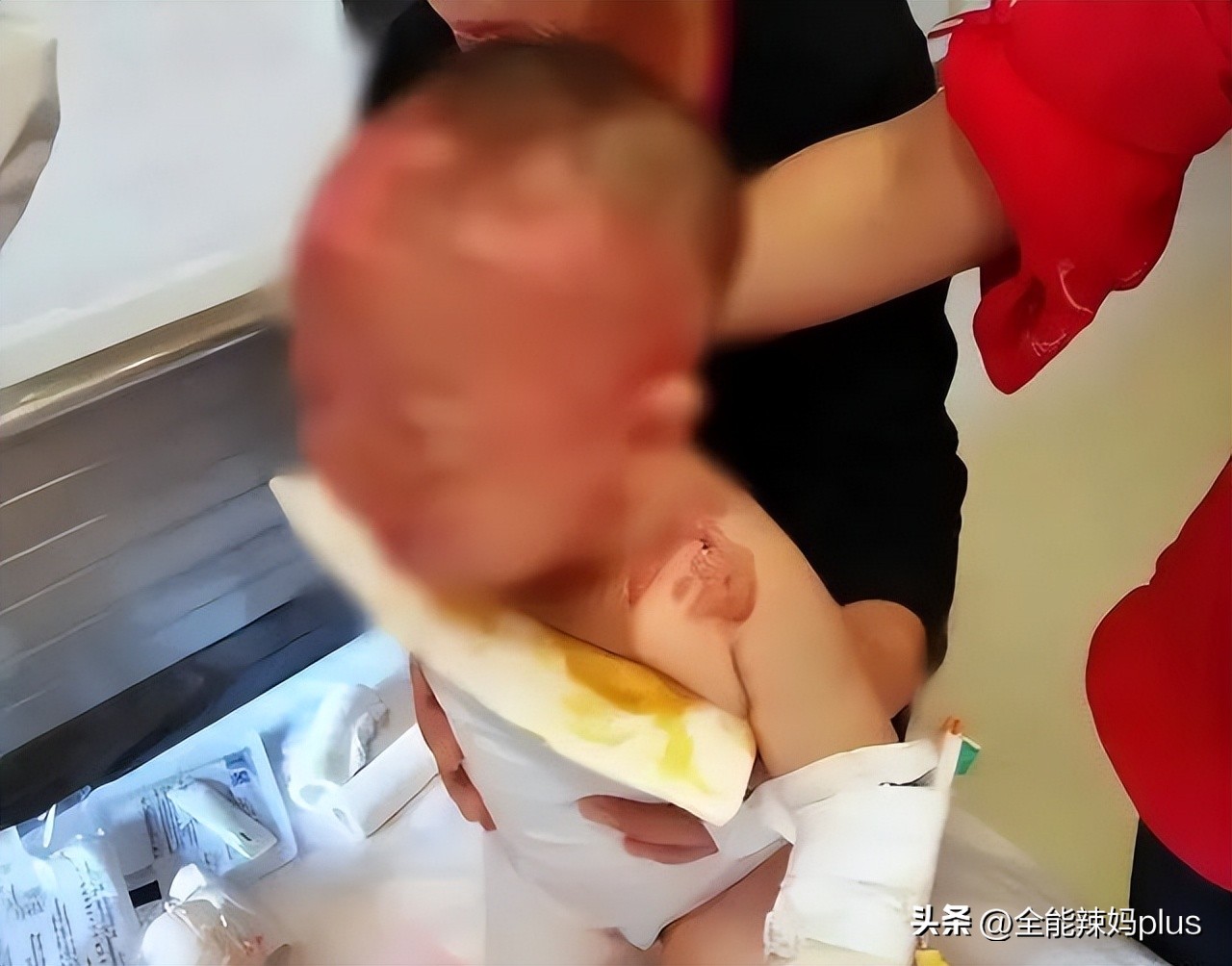 儿童开水烫伤毁容,9个月女婴被烫伤后续