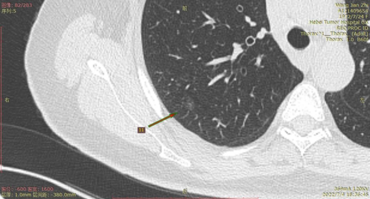 首次发现磨玻璃结节要吃药消炎吗,磨玻璃结节警惕合并占位