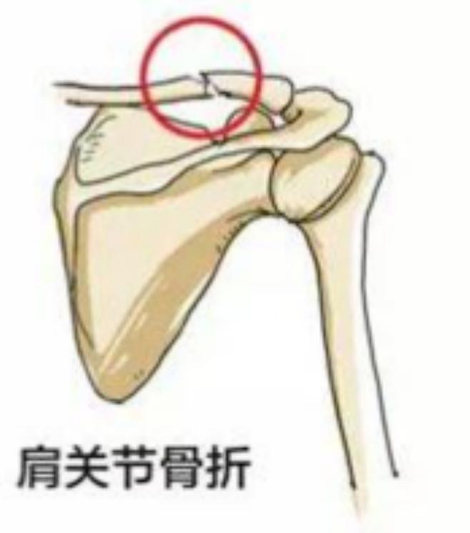 骨质疏松性骨折最常见的部位,发生骨质疏松骨折最常见的部位
