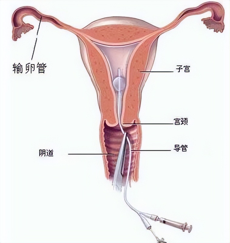 哪种结核导致不孕,结核杆菌致病吗