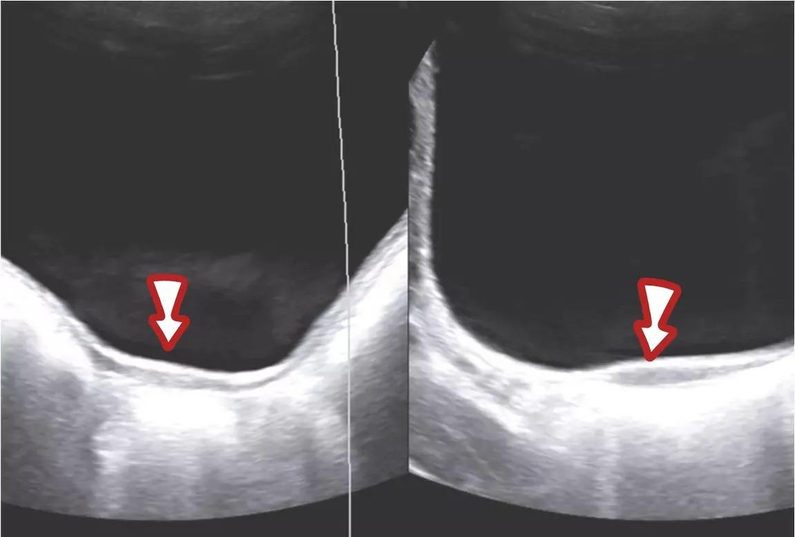 石女是怎么一回事,石女是怎么形成的