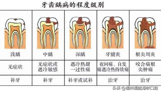 补牙太贵了？过来人表示：搞清楚2个门道后，能省不少