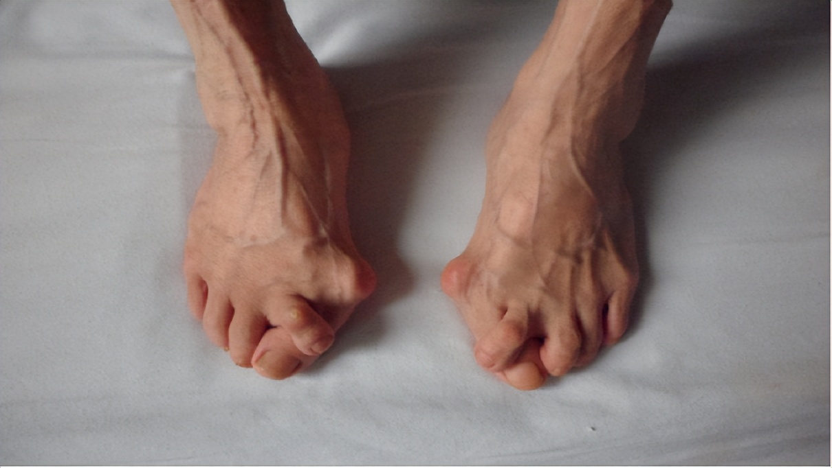 大拇脚趾往里歪怎么矫正,严重拇外翻脚趾畸形怎么办