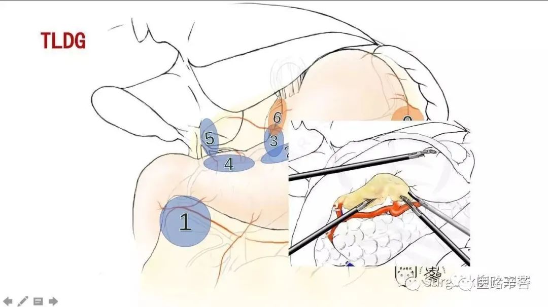 全腹腔镜胃癌根治术，学习大咖怎么清扫淋巴结