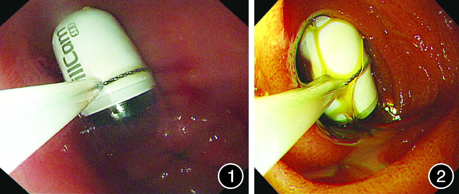 小肠造影和胶囊内镜哪个效果好,小肠胶囊内镜有必要做吗