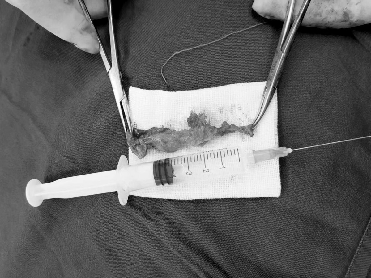 铭仁治验录之6|28岁小伙耳朵长了一个包，流脓流水不敢出门