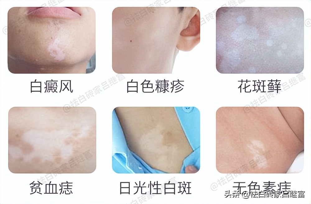 为什么白斑初期像疤一样,白斑怎么治才能彻底消除用什么药