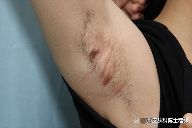 做完腋臭微创手术复发几率,腋臭手术后复发了怎么调理排毒