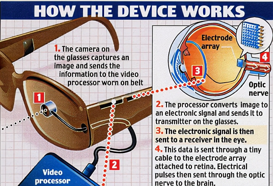 3d仿生眼镜真的有用吗,3d仿生眼球能让青光眼重见光明吗