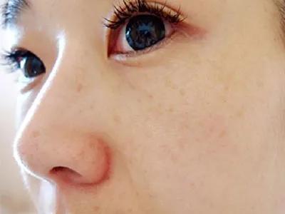 产后脸上有斑用什么药,产后脸上斑怎么快速消除