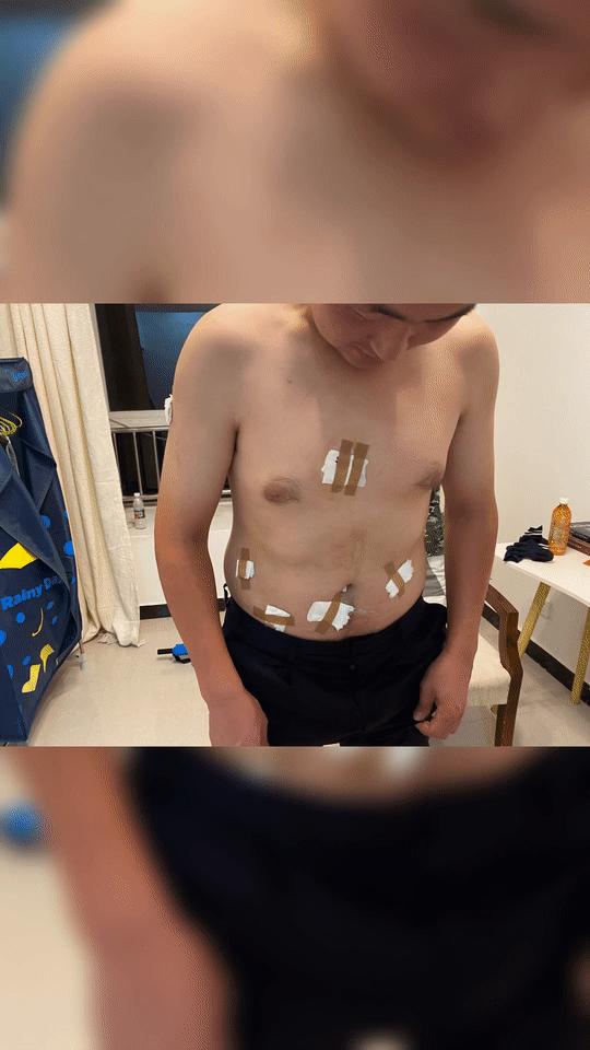 西藏民警巡逻被蚂蝗叮咬,西藏民警巡逻被35只蚂蝗咬伤