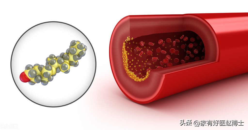 有动脉斑块必须要吃阿司匹林多久,有颈动脉斑块吃阿司匹林可以吗
