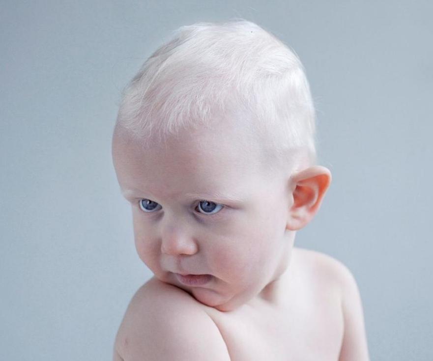 阴毛变白是身体生病了吗？