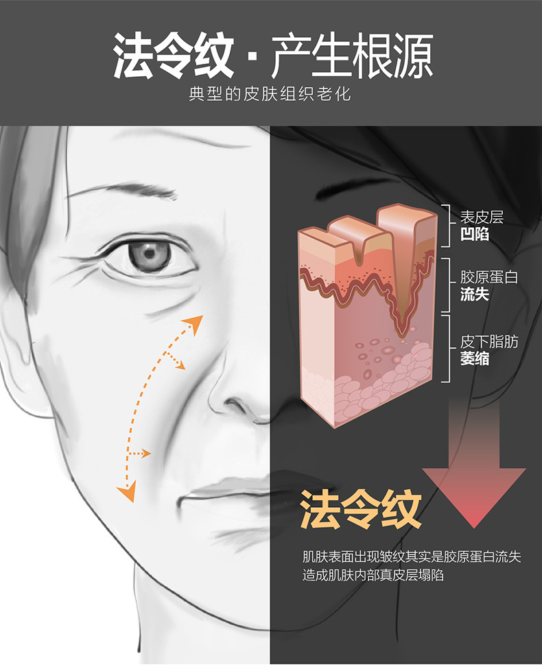 法令纹是什么原因导致的怎么改善,法令纹形成的原因及解决办法