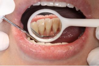 蛀牙引起的黑三角怎么治,牙齿黑三角处蛀牙怎么办