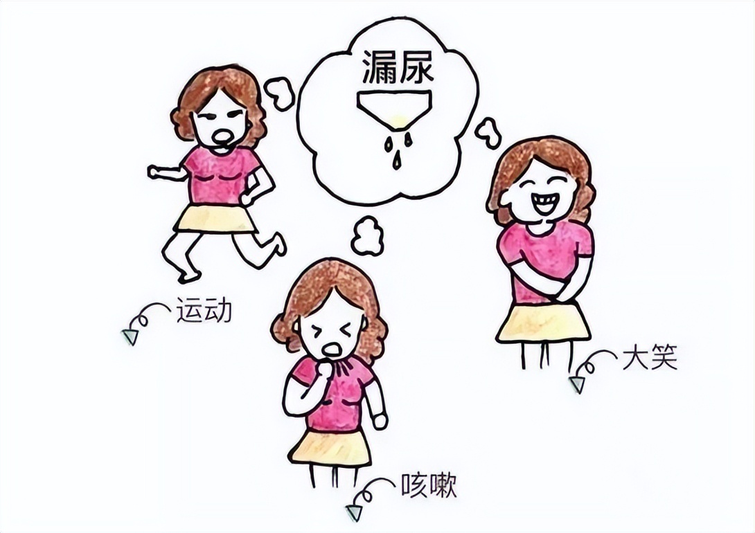 压力性漏尿艾灸哪里最有效,压力性漏尿怎么做缩肛锻炼