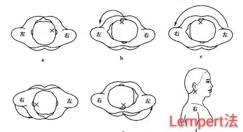 耳朵里好像有个小石头头一摇就响,耳朵里小石头掉了