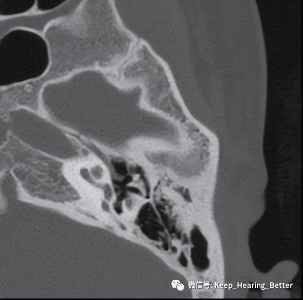 南昌大学二附院耳喉科,耳膜硬化症是什么样子