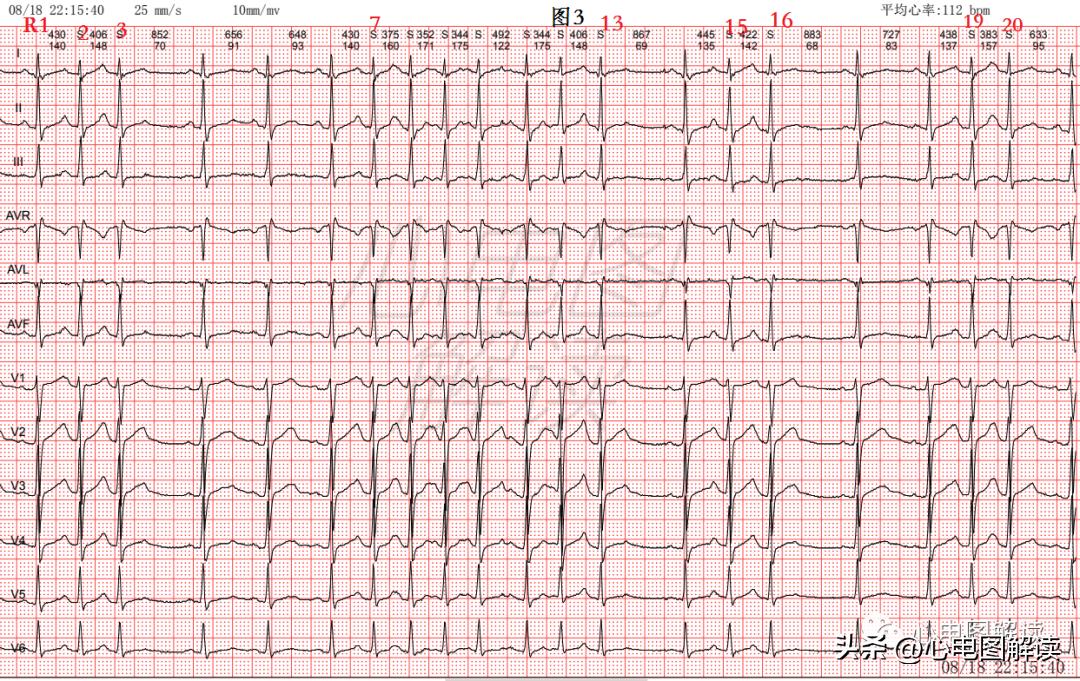 房早室早区别,房早室早房颤