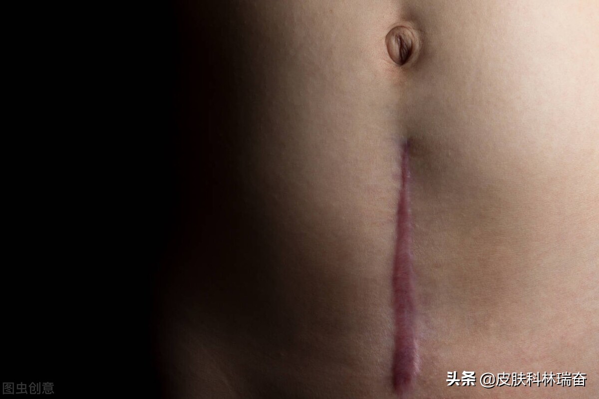 儿童一毫米深的凹陷疤痕怎么处理,各种疤的修复方法