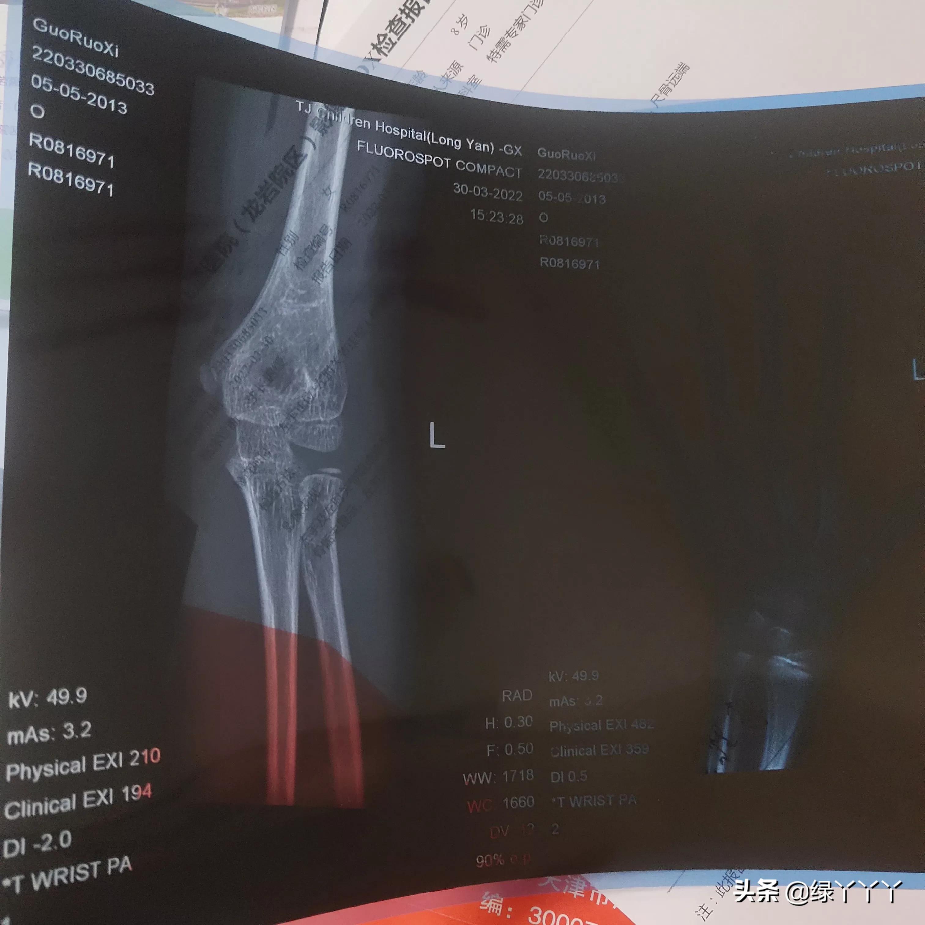 9岁孩子骨龄偏小2.5岁身高135,9岁孩子偏矮怎么办
