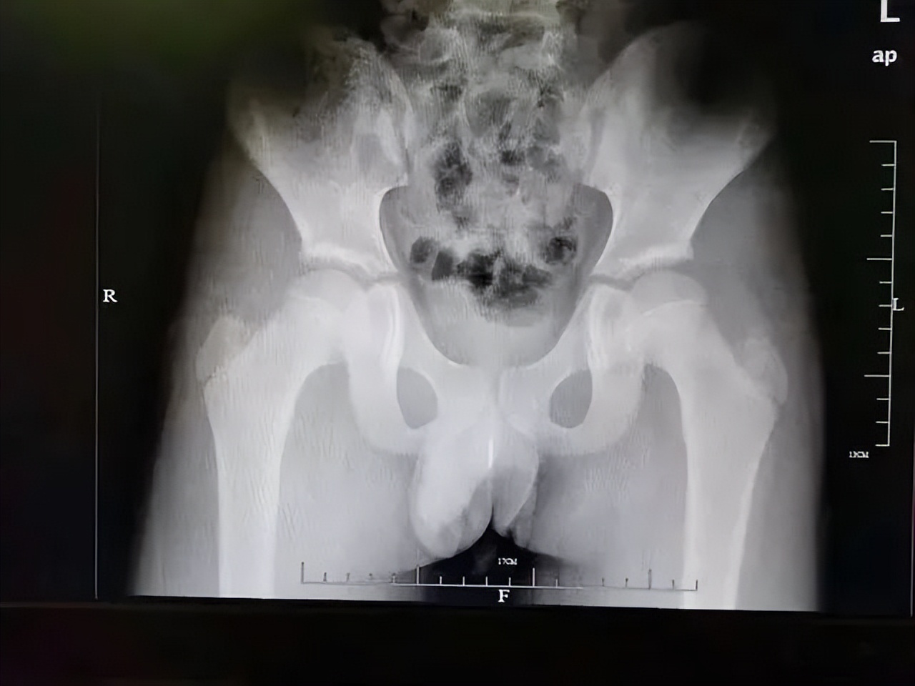 7岁女孩死亡体内却有异物,少女体内被埋神秘异物