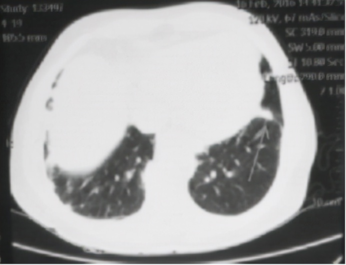 经常咳嗽检查是肺结节是怎么回事,长期咳嗽被误诊为哮喘