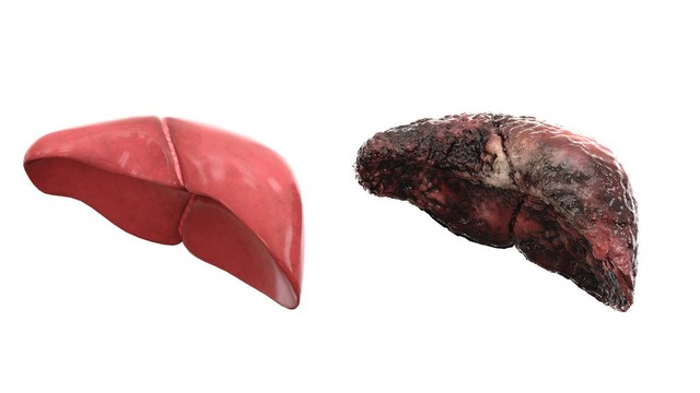 肝硬化中医如何养肝调理,瘀血肝硬化中医治疗方法