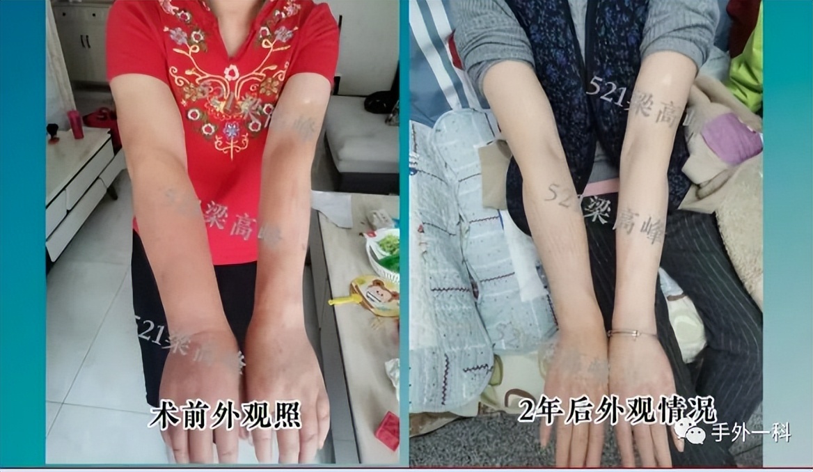 兵器工业521医院常规开展肿瘤术后淋巴水肿治疗手术