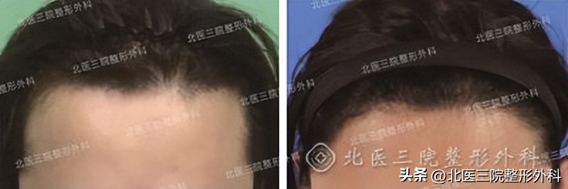 注射除皱发际线提升有什么效果,除皱注射到发际线可以提升吗