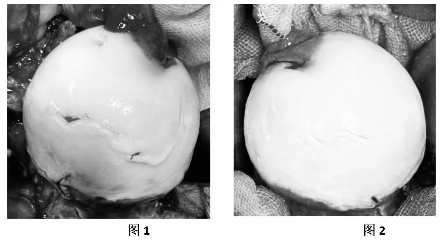 冲击波治疗股骨头坏死后拄拐吗,股骨头坏死钻孔减压要拄拐多久