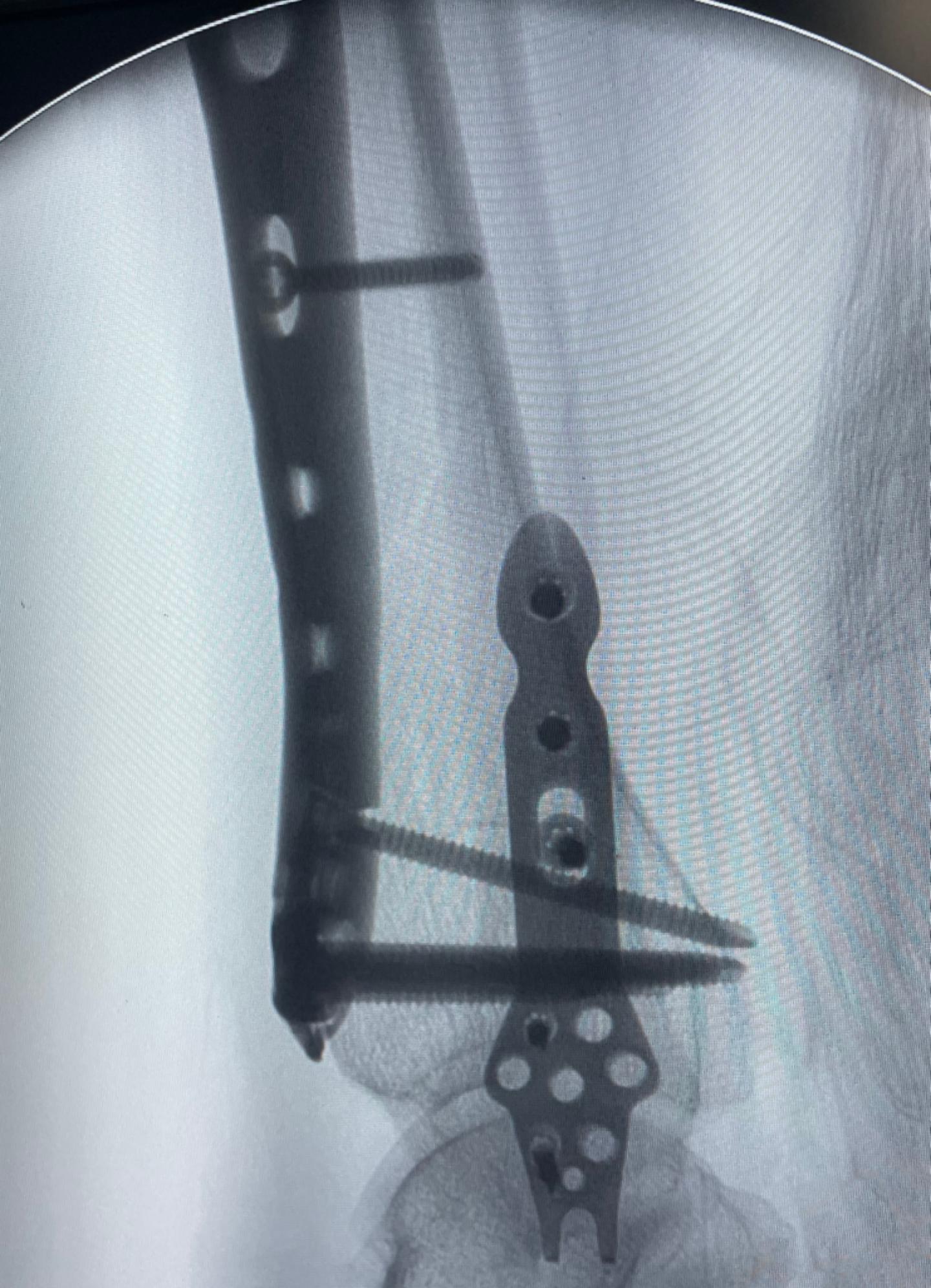 六旬大娘摔倒骨折,七旬老太太下公交车摔伤