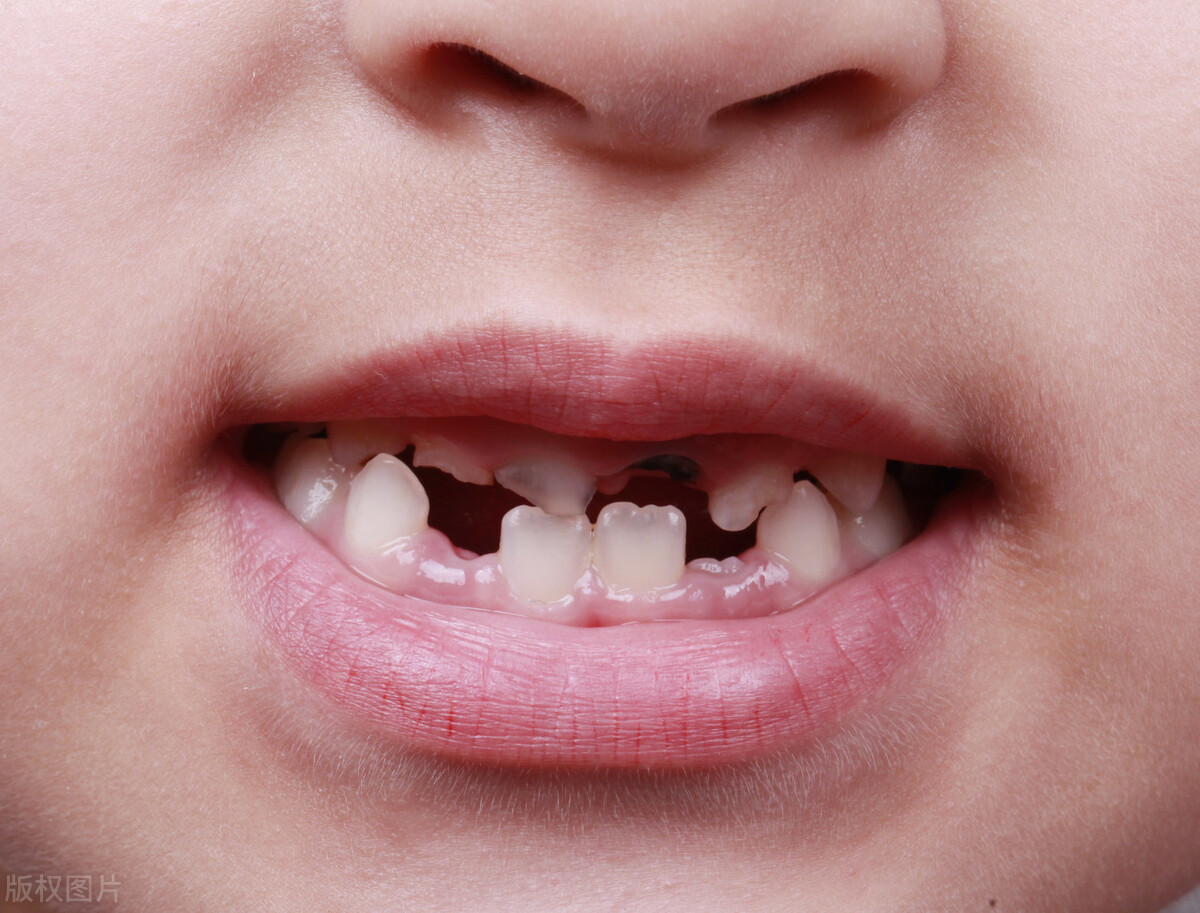 乳牙龋齿有必要治么,乳牙龋齿严重有没有补的必要