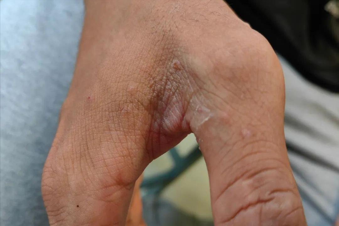 脖子前边痒是生病的前兆,腋窝和脖子痒是什么病的前兆